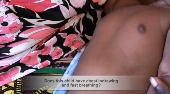 Global health Africa: paediatric respiratory signs